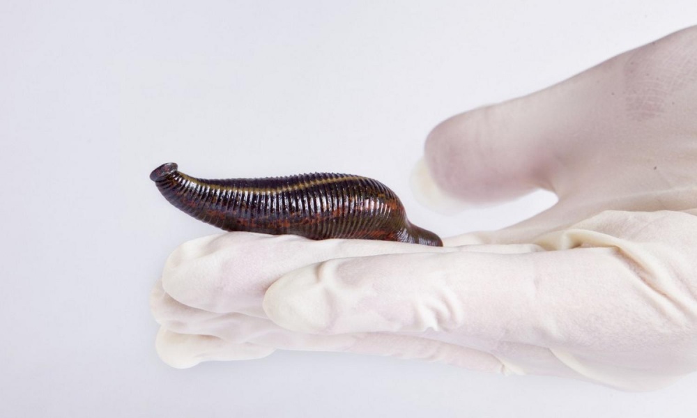 Гирудотерапия